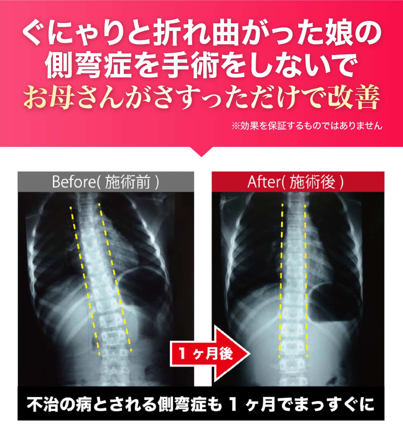 不治の病とされる側弯症も1ヶ月でまっすぐに