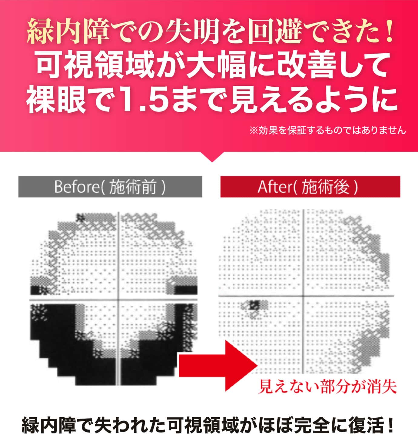 緑内障で失われた可視領域がほぼ完全に復活！